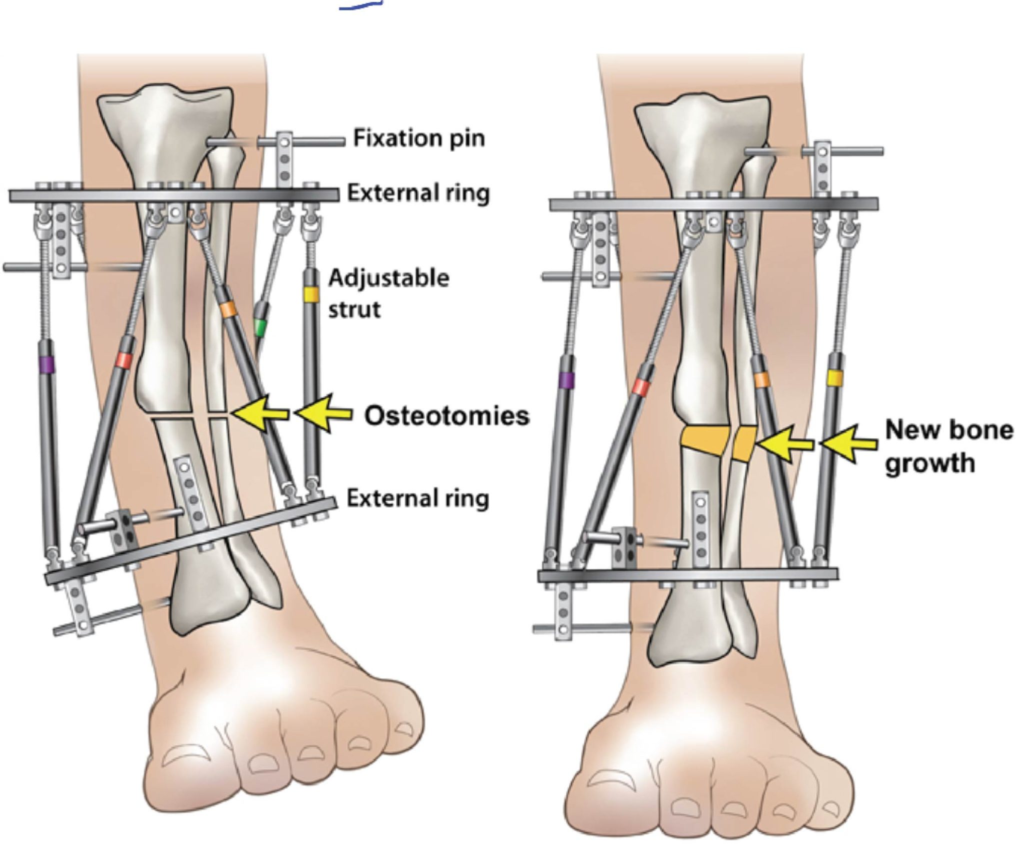The Limb Lengthening and Deformity Correction Program Elaj Medical